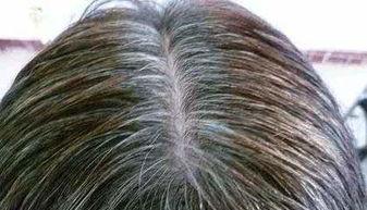 吃瓜长白头发,长白头的背后故事